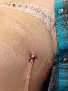 Mastectomy drain 