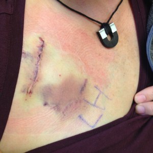 Port incision and bruise